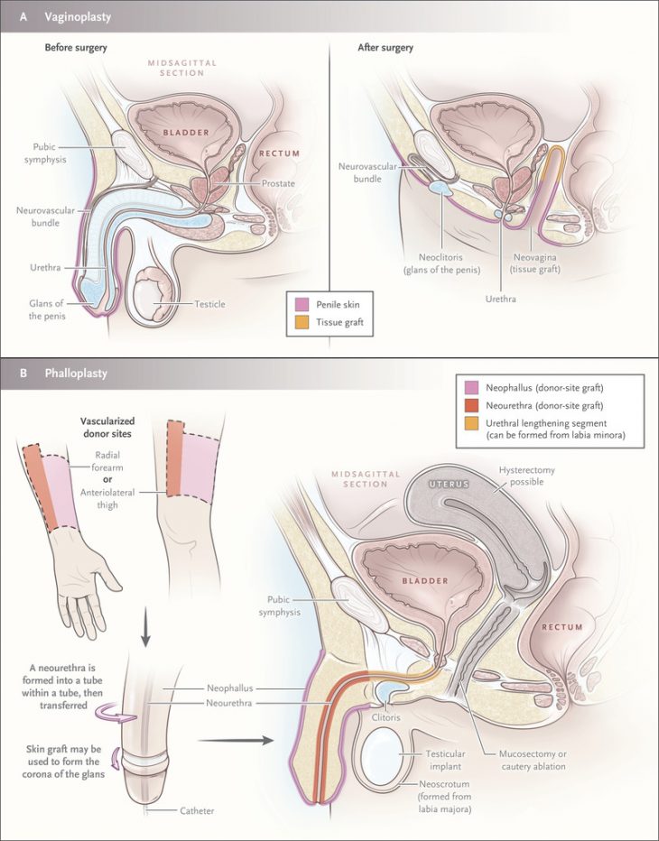 Care Of Transgender Persons | Nejm pour Reproduction Figure Cp