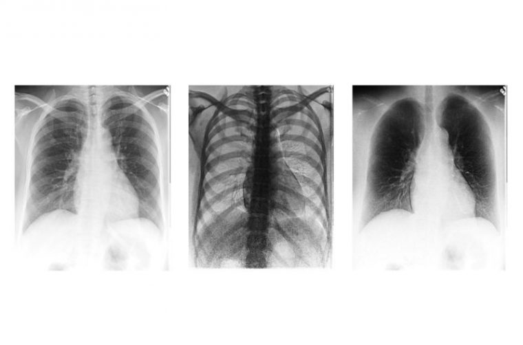 einstelltechnik röntgen thorax