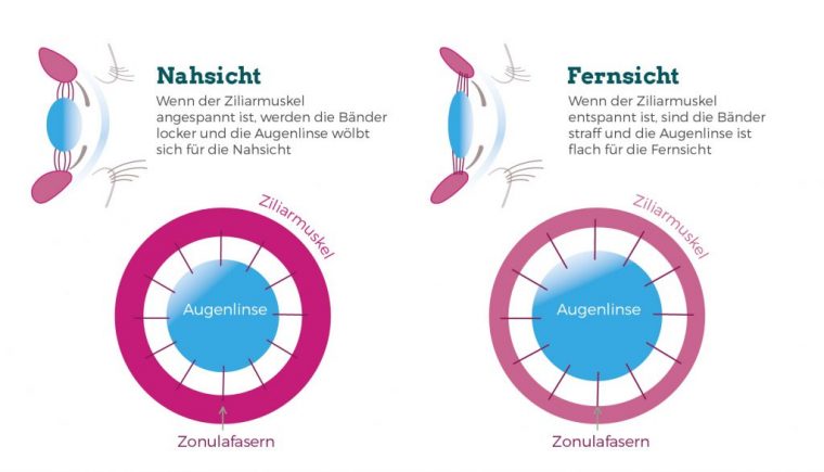 gleitsicht-kontaktlinsen erfahrungen 2019