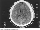 Abnormal Ct Scan Of Head Icd 10 - Ct Scan Machine concernant Lymphadenopathy Icd 10