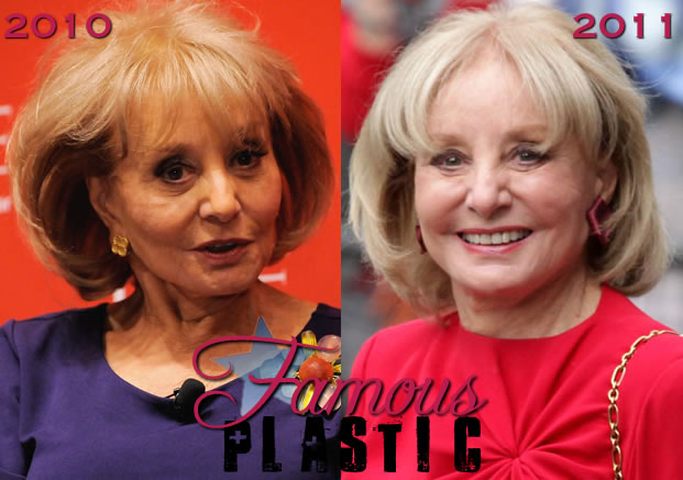 Barbara Walters Plastic Surgery Before And After Cheek concernant Fat Injections Santa Barbara 