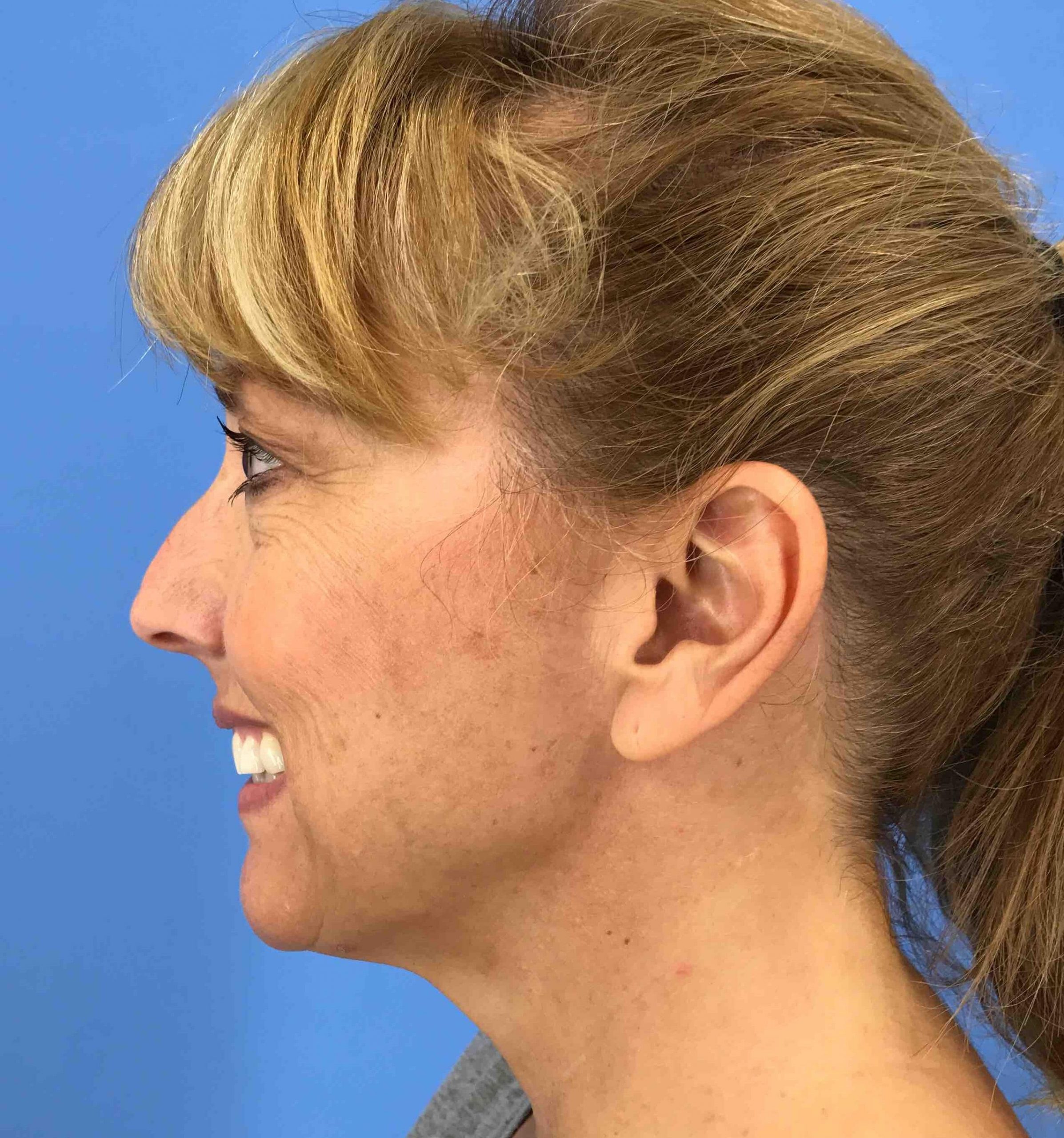 Before And After Rhinoplasty Case #39094 - Cosmeticare concernant Breast Revision Del Mar