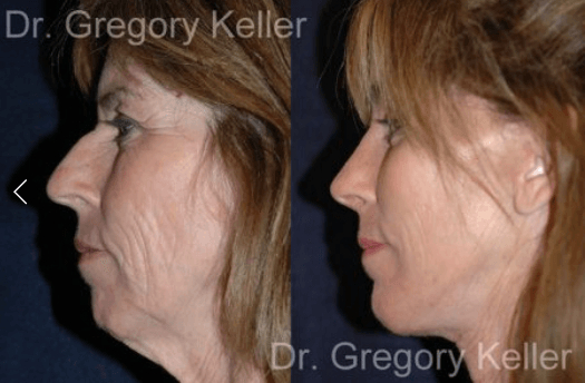 Best Rhinoplasty Santa Barbara - Keller Plastic Surgery In tout Fat Injections Santa Barbara 