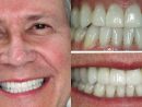 Cosmetic Dentistry Gurnee Il  Smile Design By Bradley C intérieur Dental Implants Gurnee Il