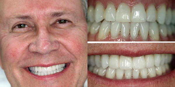 Cosmetic Dentistry Gurnee Il  Smile Design By Bradley C intérieur Dental Implants Gurnee Il 