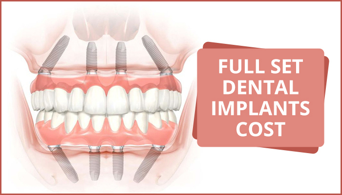 Cost Of Full Set Dental Implant - Center For Implant Dentistry intérieur Same Day Dental Implants Grass Valley, Ca 