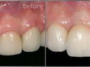 Dental Implants California - Dr. Peter Wohrle Offers Same dedans Same Day Dental Implants Grass Valley, Ca