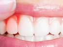 Dental Implants In Atascadero, Ca  Ck Farr Dentistry dedans Same Day Dental Implants Grass Valley, Ca