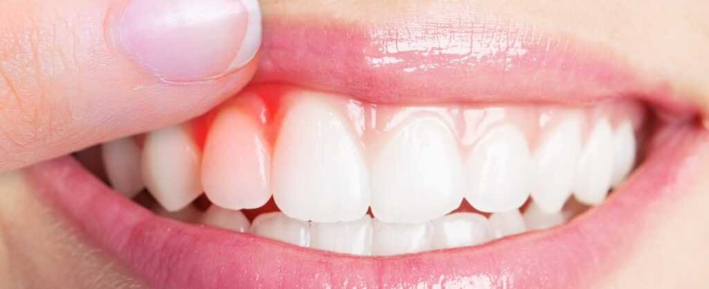 Dental Implants In Atascadero, Ca  Ck Farr Dentistry dedans Same Day Dental Implants Grass Valley, Ca 