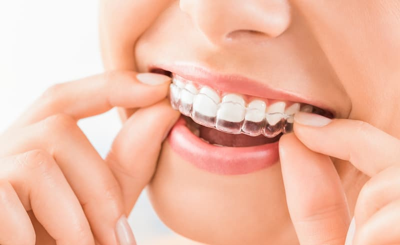 Dental Implants - Ocotillo Dental Care - Dentist - Dental avec Dentist Implants Northwest Houston