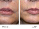 Dermal Fillers - Patient 1  Individual Results May Vary avec Breast Revision Del Mar