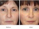 Eye Cosmetic Surgery - Patient 3  Individual Results May Vary tout Breast Revision Del Mar