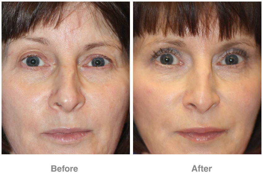 Eye Cosmetic Surgery - Patient 3  Individual Results May Vary tout Breast Revision Del Mar