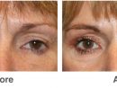 Eye Cosmetic Surgery - Patient 7  Individual Results May Vary concernant Breast Revision Del Mar