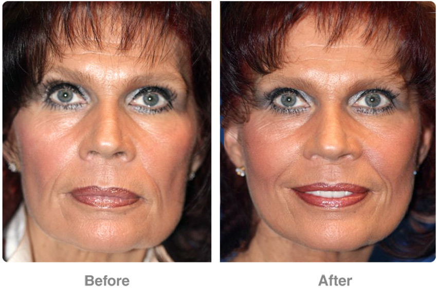 Face  Mid-Face Lifts - Patient 2  Individual Results May encequiconcerne Breast Revision Del Mar
