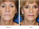 Face  Mid-Face Lifts - Patient 2  Individual Results May serapportantà Breast Revision Del Mar