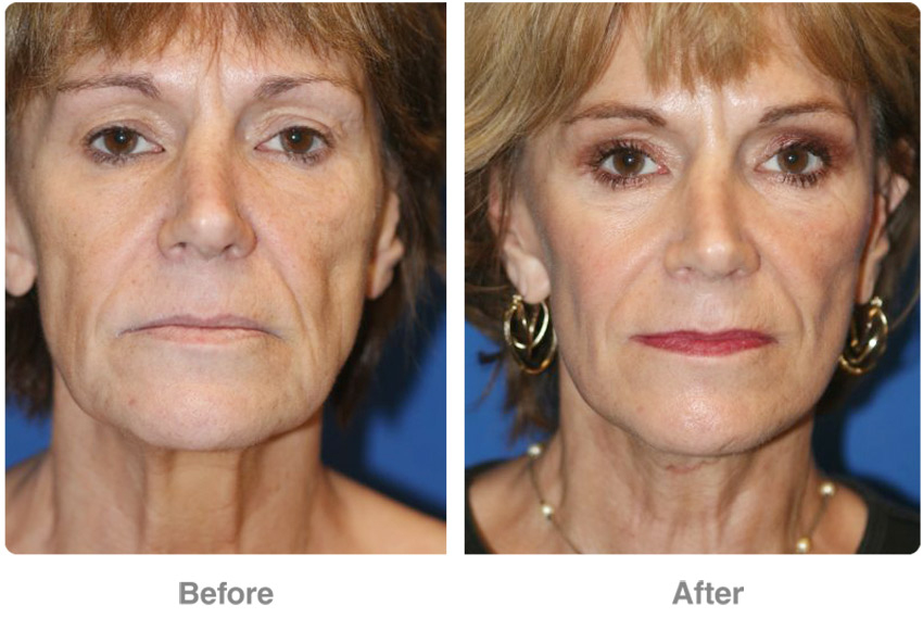 Face  Mid-Face Lifts - Patient 2  Individual Results May serapportantà Breast Revision Del Mar 