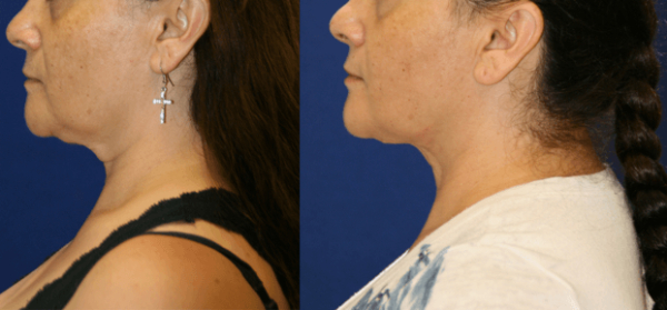 Facetite Before And Afters Beverly Hills - Keller Plastic avec Fat Injections Santa Barbara 