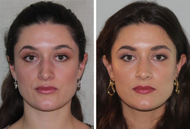 Female Rhinoplasty  Dr Garrett Bennett – Ny Sinus concernant Manhattan Septum Perforation Repair Surgery