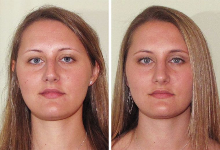 Female Rhinoplasty  Dr Garrett Bennett – Ny Sinus destiné Manhattan Septum Perforation Repair Surgery