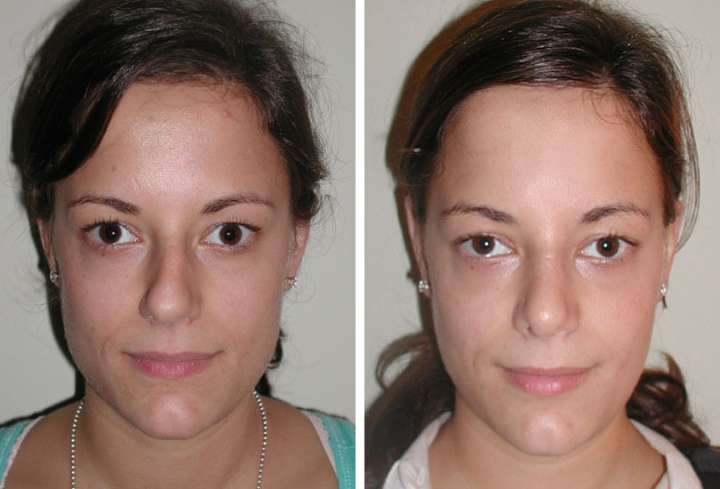 Female Rhinoplasty  Dr Garrett Bennett - Ny Sinus intérieur Manhattan Septum Perforation Repair Surgery