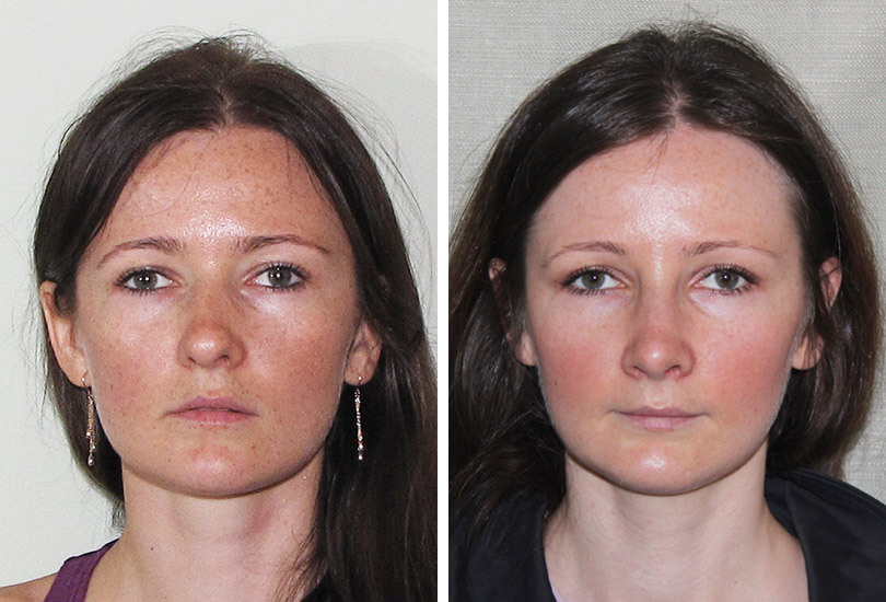 Female Rhinoplasty  Dr Garrett Bennett - Ny Sinus pour Manhattan Septum Perforation Repair Surgery 