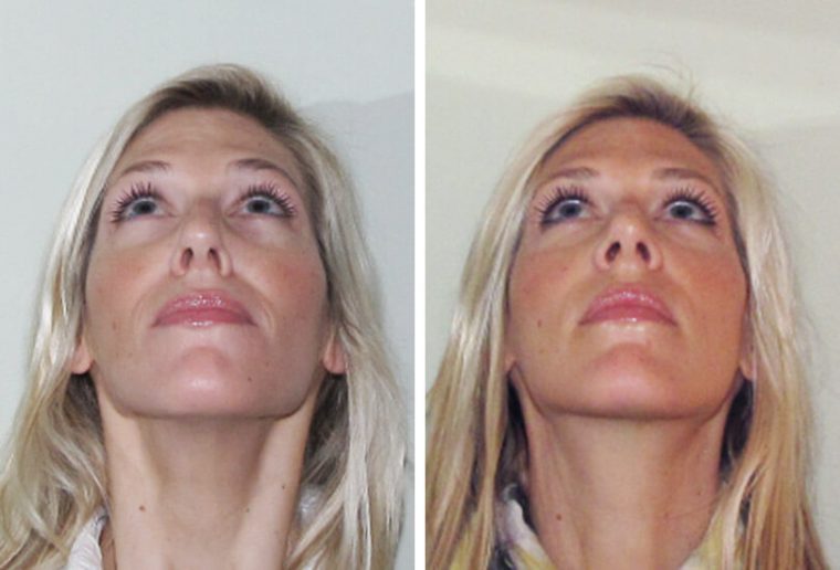 Female Rhinoplasty  Dr Garrett Bennett – Ny Sinus serapportantà Manhattan Septum Perforation Repair Surgery