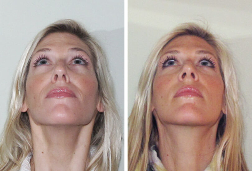 Female Rhinoplasty  Dr Garrett Bennett - Ny Sinus serapportantà Manhattan Septum Perforation Repair Surgery 