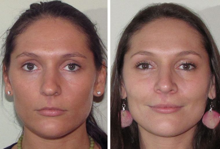 Female Rhinoplasty  Dr Garrett Bennett – Ny Sinus serapportantà Manhattan Septum Perforation Repair Surgery