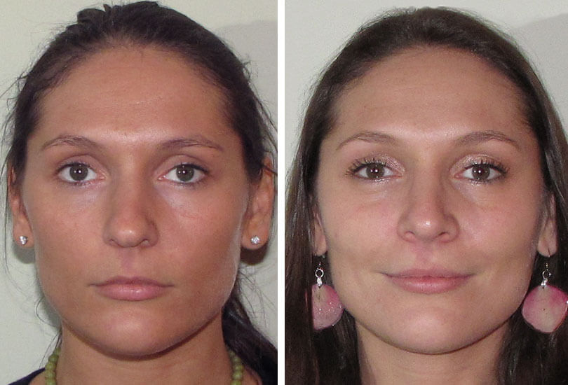 Female Rhinoplasty  Dr Garrett Bennett - Ny Sinus serapportantà Manhattan Septum Perforation Repair Surgery 