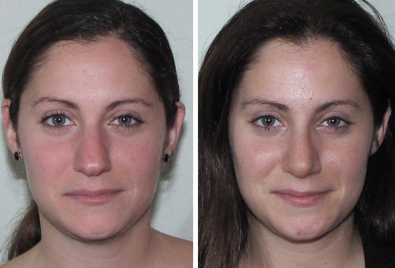 Female Rhinoplasty  Dr Garrett Bennett - Ny Sinus tout Manhattan Septum Perforation Repair Surgery 