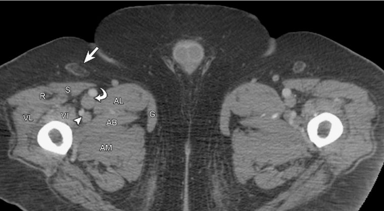 Figure 3 From Inguinal Lymph Nodes: Size, Number, And dedans Lymphadenopathy Icd 10