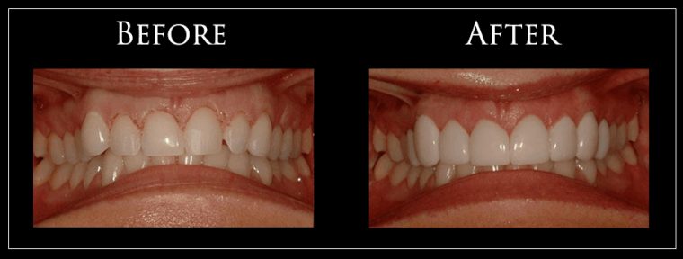 Gallery  Dentist In Virginia Beach, Va concernant Front Tooth Implant Virginia Beach, Va