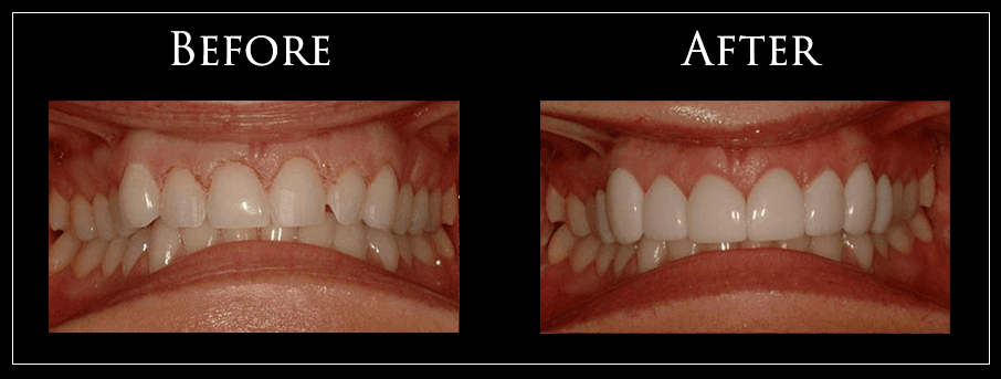 Gallery  Dentist In Virginia Beach, Va concernant Front Tooth Implant Virginia Beach, Va 