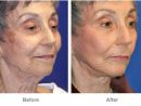 Laser Skin Resurfacing - Patient 10  Individual Results avec Breast Revision Del Mar