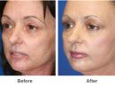 Laser Skin Resurfacing - Patient 3  Individual Results dedans Breast Revision Del Mar