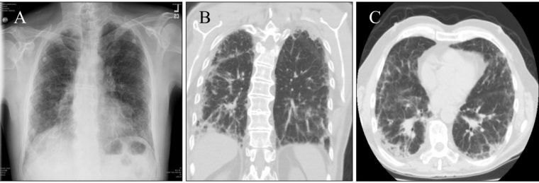 Lymphomatoid Granulomatosis Masquerading As Interstitial avec Lymphadenopathy Icd 10