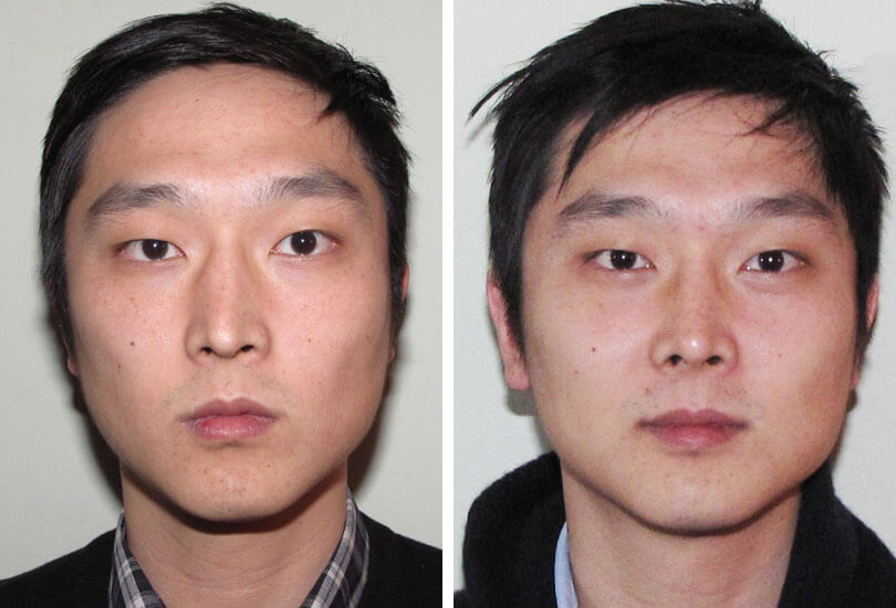 Male Rhinoplasty  Dr Garrett Bennett - Ny Sinus destiné Manhattan Septum Perforation Repair Surgery 