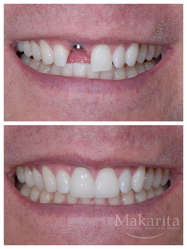 Missing Tooth Replacement - East Beach Smiles encequiconcerne Front Tooth Implant Virginia Beach, Va 