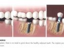 New Jersey (Nj) Dental Implants - Dr. James Courey serapportantà Dental Implants Monmouth County