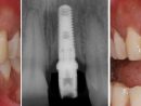 Nw Houston Prosthodontics - Dental Implant Gallery serapportantà Dentist Implants Northwest Houston