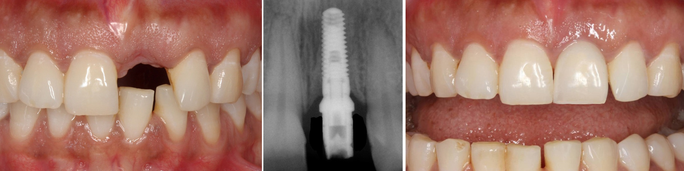 Nw Houston Prosthodontics - Dental Implant Gallery serapportantà Dentist Implants Northwest Houston