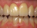 Patient Gallery - Before And After Photos  Weston Spencer Dds pour Same Day Dental Implants Grass Valley, Ca