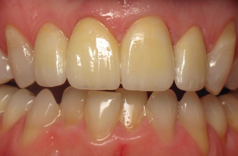 Patient Gallery – Before And After Photos  Weston Spencer Dds pour Same Day Dental Implants Grass Valley, Ca