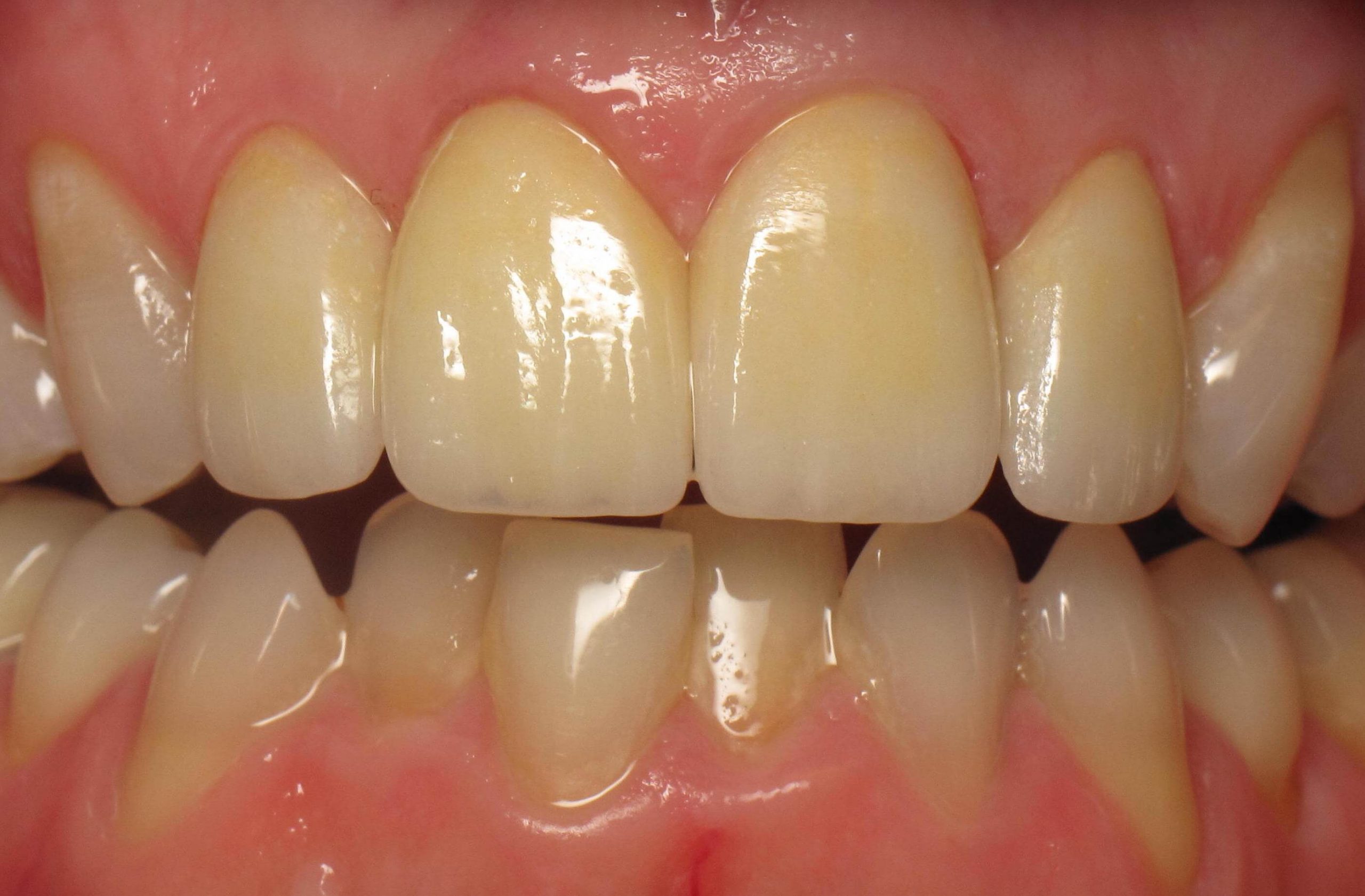 Patient Gallery - Before And After Photos  Weston Spencer Dds pour Same Day Dental Implants Grass Valley, Ca 