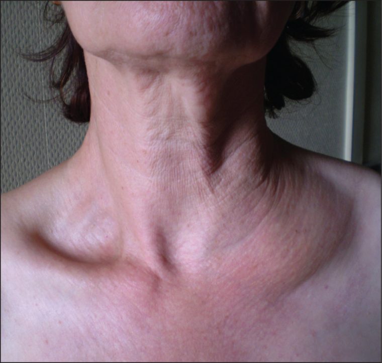 Recurrent Lymphangiectasia Of The Left Supraclavicular destiné Lymphadenopathy Icd 10