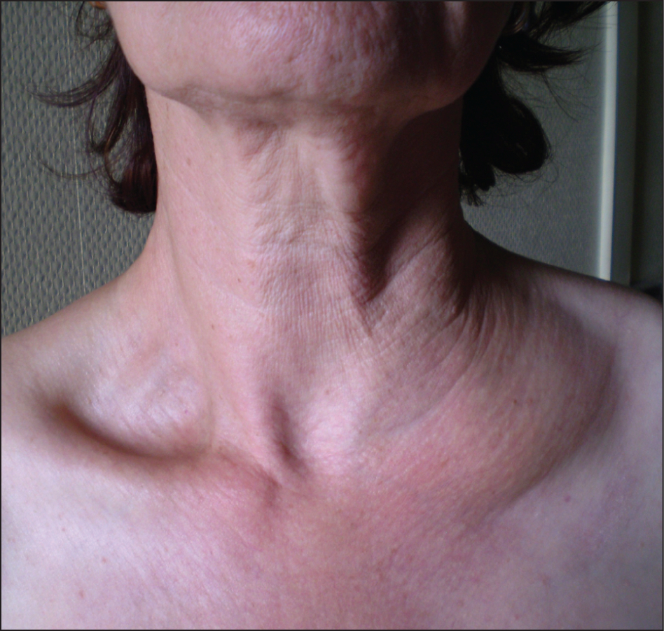 Recurrent Lymphangiectasia Of The Left Supraclavicular destiné Lymphadenopathy Icd 10 