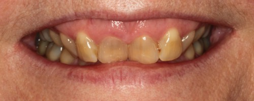 Smile Gallery - Dentist Virginia Beach avec Front Tooth Implant Virginia Beach, Va 