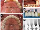 Smile Gallery  North Houston Periodontics &amp; Dental Implants pour Dentist Implants Northwest Houston