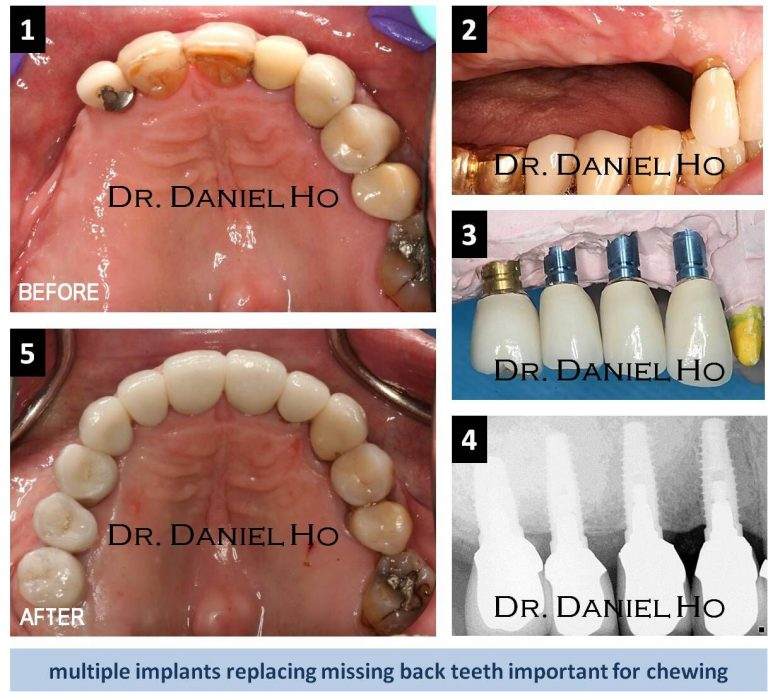 Smile Gallery  North Houston Periodontics &amp;amp; Dental Implants pour Dentist Implants Northwest Houston 